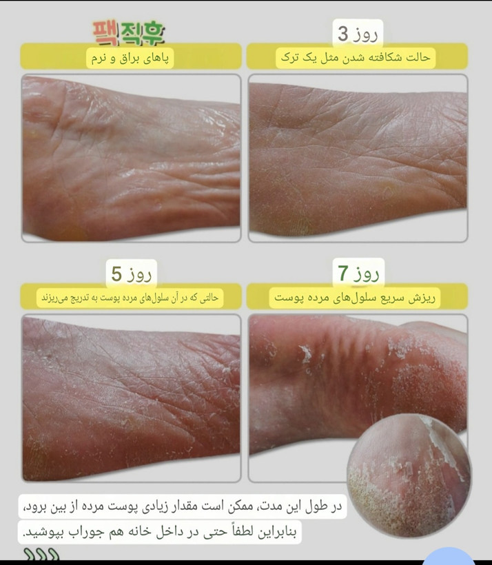 ماسک لایه بردار پا الیزاووکا