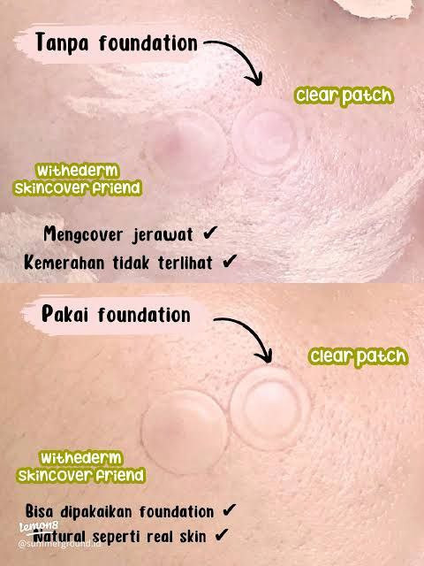 پچ جوش Withederm