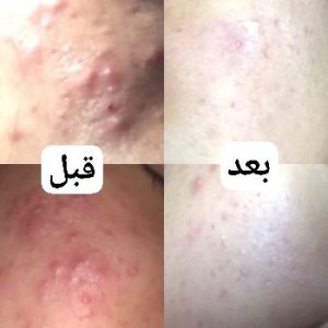 لیکوئید سالیسیلیک اسید و نیاسینامید کاز دی باها