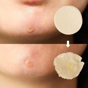 پچ های جوش هیدروکلوئید الیزاوکا